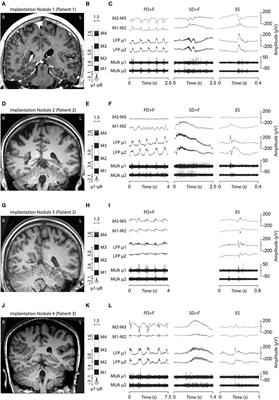 Human periventricular nodular heterotopia shows several interictal epileptic patterns and hyperexcitability of neuronal firing